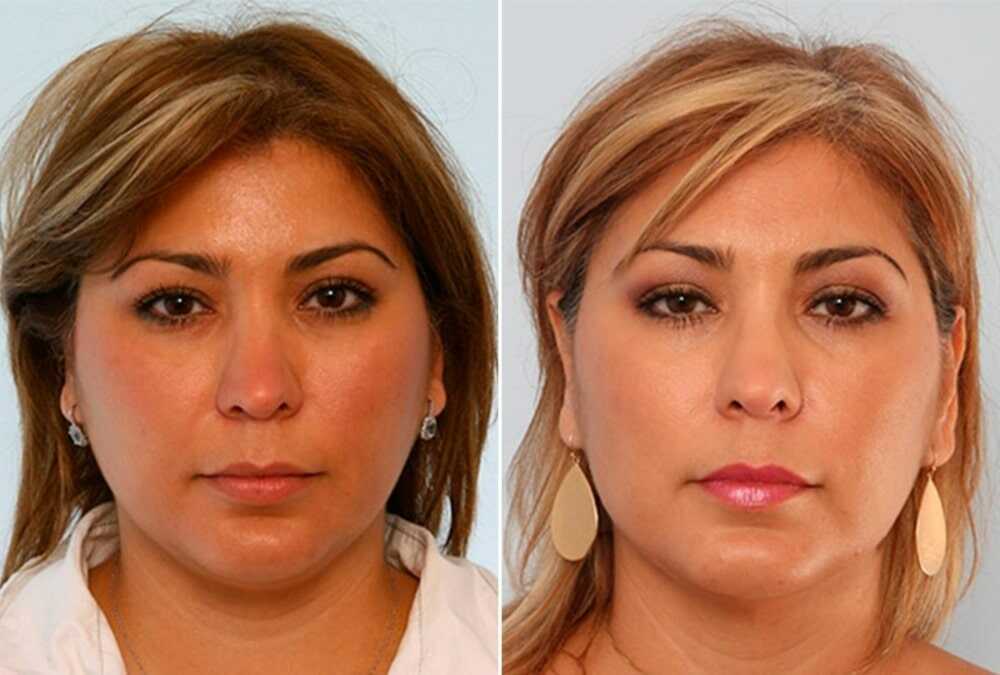 Buccal Fat Removal Cost 