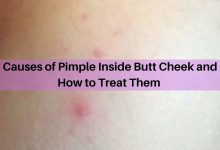 pimple inside buttcheek