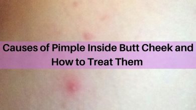 pimple inside buttcheek