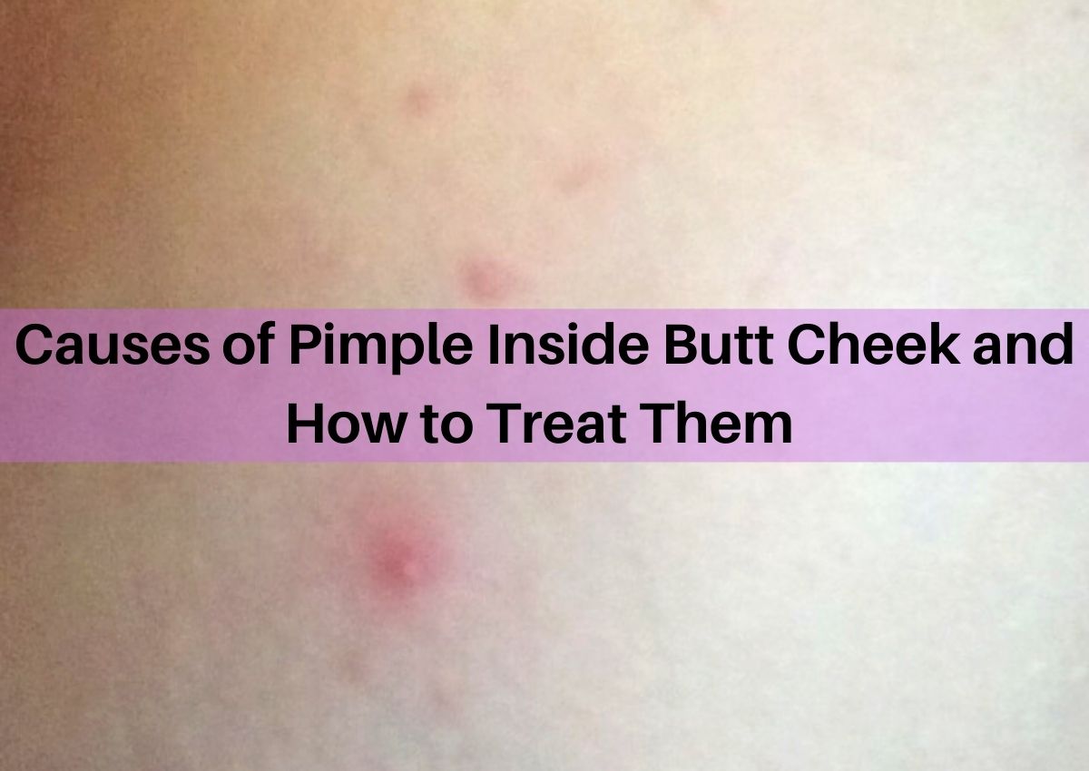 causes-of-pimple-inside-buttcheek-and-how-to-treat-them