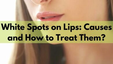 White Spots on Lips