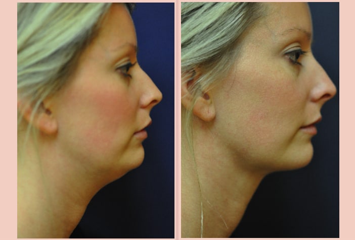 What is a Double Chin Liposuction? 