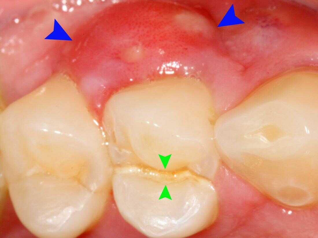 What Are White Bumps on Gums