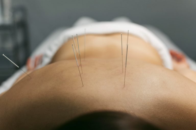 City Acupuncture