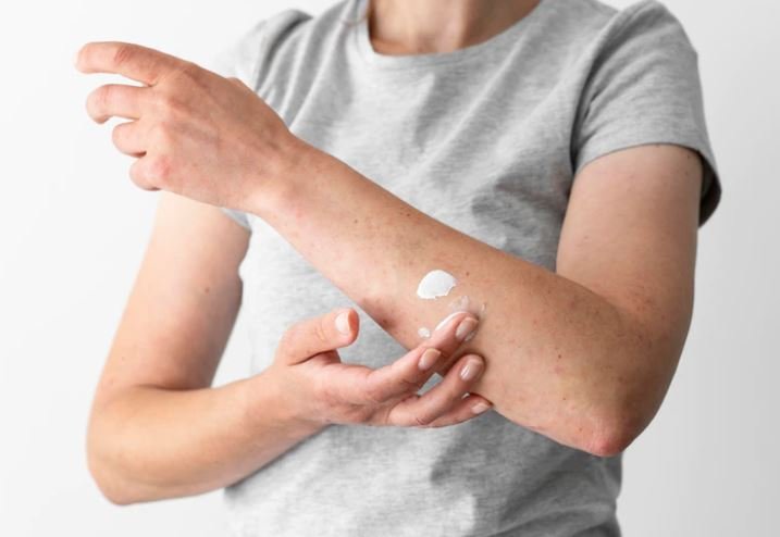 Ringworm vs Nummular Eczema