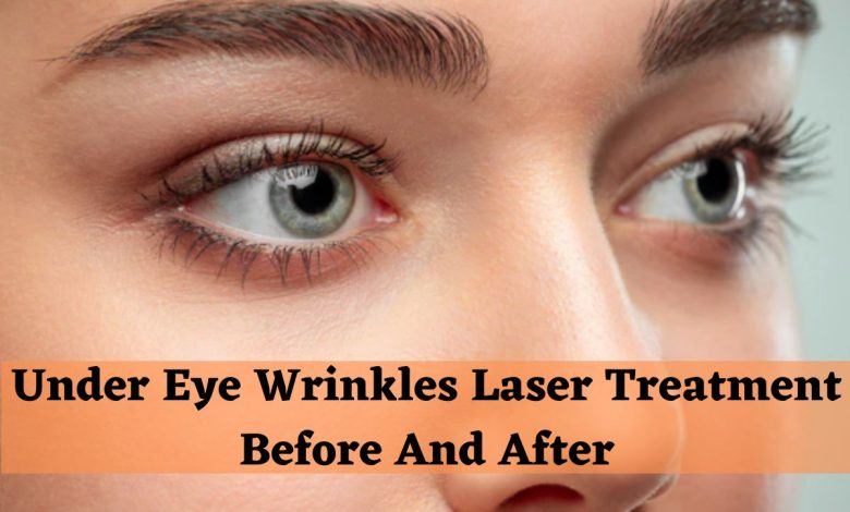 under eye laser treatment before and after