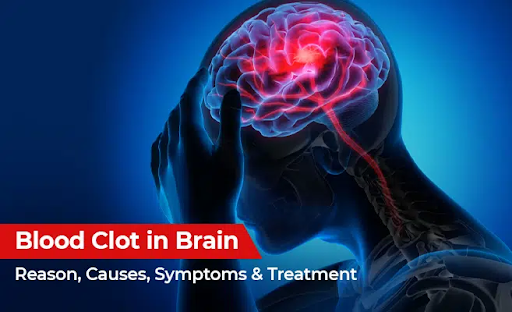 what causes blood clot in brain