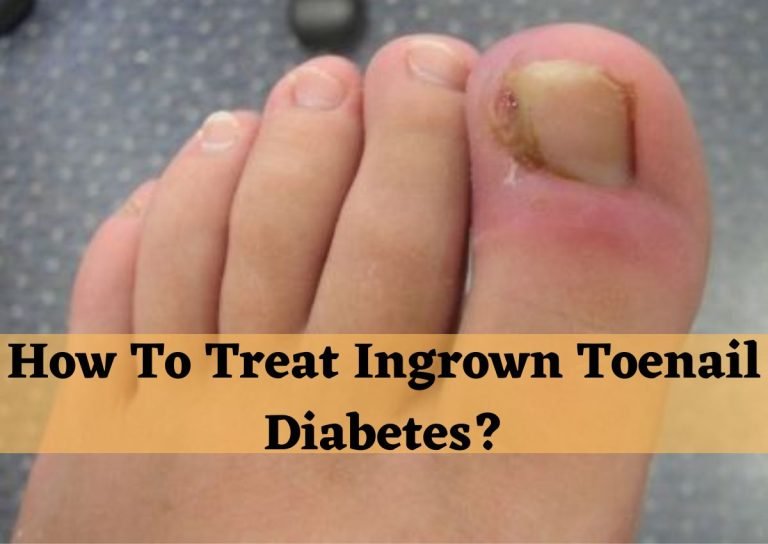 How To Treat Ingrown Toenail Diabetes?