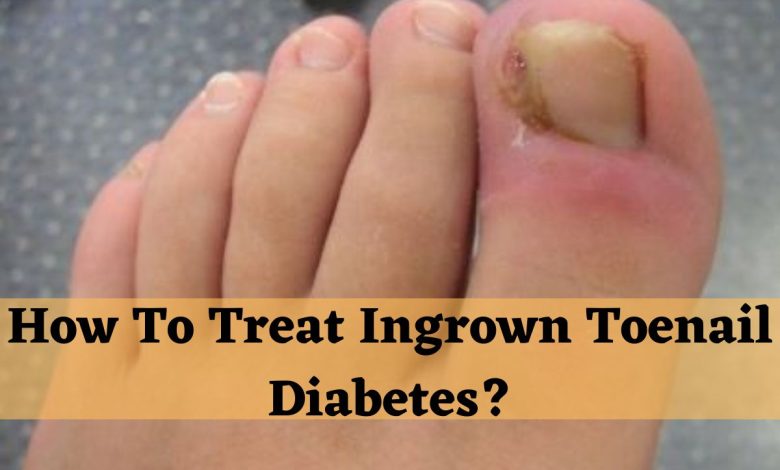 How To Treat Ingrown Toenail Diabetes?