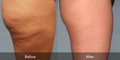 Does Red Light Therapy Help Cellulite? 