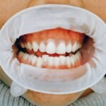 Why Bleeding Gums Shouldn’t Be Ignored